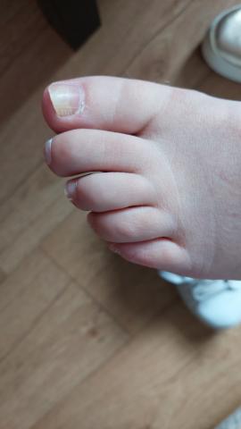 Wat is de oorzaak van deze loslatende nagel?