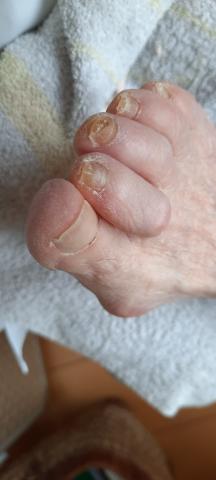 Wat is het advies bij deze groeistoornis