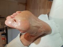 Hoe ontstaan deze losse vellen op de voeten en hoe behandel je ze Miniatuurvoorbeeld