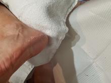 Hoe ontstaan deze losse vellen op de voeten en hoe behandel je ze2 Miniatuurvoorbeeld