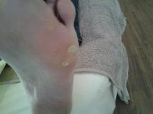 Als deze plekjes geen wratjes zijn, wat zijn het dan - 1 Miniatuurvoorbeeld