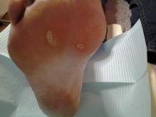 Als deze plekjes geen wratjes zijn, wat zijn het dan - 2 Miniatuurvoorbeeld