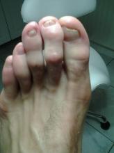 Helpen gelnagels in dit geval de groei weer normaal te worden - 1 Miniatuurvoorbeeld