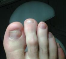 Helpen gelnagels in dit geval de groei weer normaal te worden - 2 Miniatuurvoorbeeld