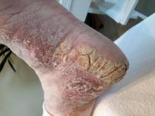 Hoe kan dit vele eelt het beste worden weggehaald - 1 Miniatuurvoorbeeld