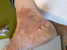 Hoe kan dit vele eelt het beste worden weggehaald - 2 Miniatuurvoorbeeld