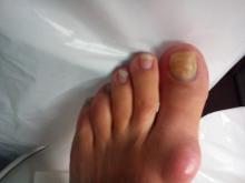 Hoe kan ik mijn behandeling van deze loslatende nagels aanpassen - 1 Miniatuurvoorbeeld