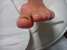 Hoe kan ik mijn behandeling van deze loslatende nagels aanpassen - 2 Miniatuurvoorbeeld