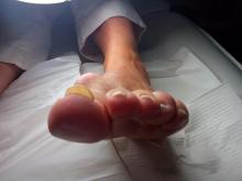 Hoe kan ik mijn behandeling van deze loslatende nagels aanpassen - 3 Miniatuurvoorbeeld