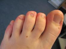 Hoe komt mevrouw aan dit overtollige eelt - 1 Miniatuurvoorbeeld