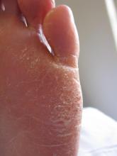 Hoe komt mevrouw aan dit overtollige eelt - 2 Miniatuurvoorbeeld