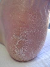 Hoe komt mevrouw aan dit overtollige eelt - 3 Miniatuurvoorbeeld