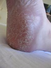 Hoe komt mevrouw aan dit overtollige eelt - 4 Miniatuurvoorbeeld