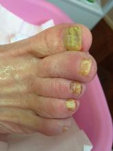 Is de anti-mycotica verantwoordelijk voor de achteruitgang van de structuur van de nagel - 1 Miniatuurvoorbeeld