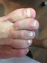 Is de anti-mycotica verantwoordelijk voor de achteruitgang van de structuur van de nagel - 2 Miniatuurvoorbeeld