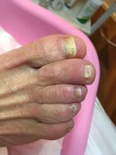 Is de anti-mycotica verantwoordelijk voor de achteruitgang van de structuur van de nagel - 3 Miniatuurvoorbeeld