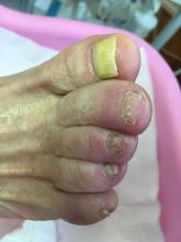 Is de anti-mycotica verantwoordelijk voor de achteruitgang van de structuur van de nagel - 4 Miniatuurvoorbeeld