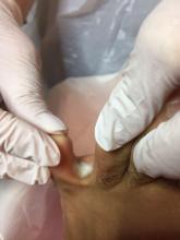 Kan deze verweking tussen de tenen zijn ontstaan na het gebruik van een schimmeldodend middel - 1 Miniatuurvoorbeeld