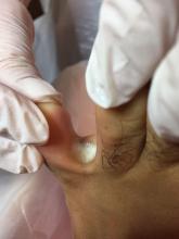 Kan deze verweking tussen de tenen zijn ontstaan na het gebruik van een schimmeldodend middel - 2 Miniatuurvoorbeeld