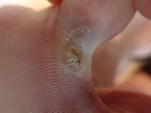 Wat betekenen deze plekken op de huid - 1 Miniatuurvoorbeeld