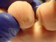 Wat betekenen deze plekken op de huid - 2 Miniatuurvoorbeeld