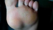 Wat betekenen deze plotselinge zweetvoeten en pijnlijke plekken onder de voeten - 3 Miniatuurvoorbeeld