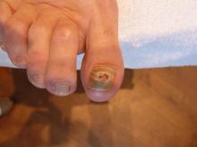 Wat betekent deze nagelverkleuring bij mijn cliënt die lijdt aan de ziekte Besnier Boeck - 1 Miniatuurvoorbeeld