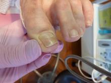 Wat betekent deze nagelverkleuring bij mijn cliënt die lijdt aan de ziekte Besnier Boeck - 2 Miniatuurvoorbeeld