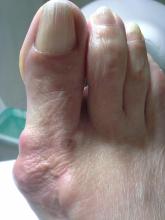 Wat is de bult naast de hallux valgus - 1 Miniatuurvoorbeeld
