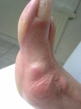 Wat is de bult naast de hallux valgus - 2 Miniatuurvoorbeeld