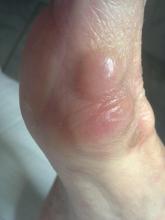 Wat is de bult naast de hallux valgus - 3 Miniatuurvoorbeeld