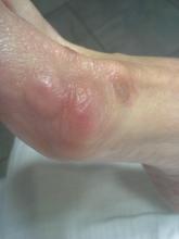 Wat is de bult naast de hallux valgus - 4 Miniatuurvoorbeeld