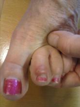 Wat is dit wel, want het is geen likdoorn Miniatuurvoorbeeld