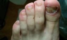 Wat is er met deze nagels aan de hand - 1 Miniatuurvoorbeeld