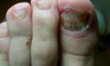 Wat is er met deze nagels aan de hand - 2 Miniatuurvoorbeeld