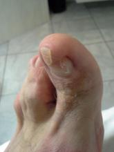 Wat kan ik aan de nagel hallux L van deze meneer doen zodat deze weer heel wordt Miniatuurvoorbeeld