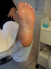 Wat kan ik deze cliënt adviseren, die enorme blaren heeft na een wandeling van 5 minuten - 1 Miniatuurvoorbeeld