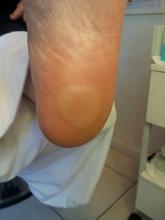 Wat kan ik deze cliënt adviseren, die enorme blaren heeft na een wandeling van 5 minuten - 3 Miniatuurvoorbeeld