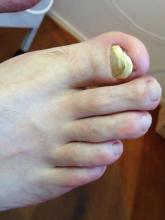 Wat kan ik meneer adviseren Het lijkt op stoot- en of schimmelnagels - 1 Miniatuurvoorbeeld