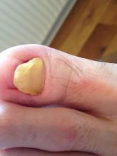 Wat kan ik meneer adviseren Het lijkt op stoot- en of schimmelnagels - 2 Miniatuurvoorbeeld