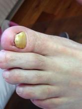 Wat kan ik meneer adviseren Het lijkt op stoot- en of schimmelnagels - 3 Miniatuurvoorbeeld