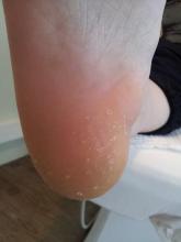 Zijn deze putjes psoriasis - 1 Miniatuurvoorbeeld