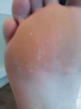 Zijn deze putjes psoriasis - 2 Miniatuurvoorbeeld