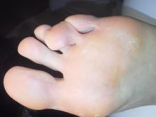 Zou deze jonge cliënte iets moeten laten doen aan haar gebogen teen - 1 Miniatuurvoorbeeld