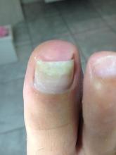 Zou een beugel hier helpen de nagelplaat te reguleren - 2 Miniatuurvoorbeeld