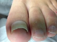 Zou een beugel hier helpen de nagelplaat te reguleren - 3 Miniatuurvoorbeeld