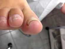 Zou een beugel hier helpen de nagelplaat te reguleren - 4 Miniatuurvoorbeeld