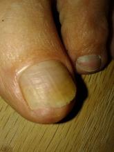 deze klant heeft rechts en links mycosenagels gehad bij digi 1 Nu groeien ze weer, maar de nagel bl - 1 Miniatuurvoorbeeld