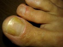 deze klant heeft rechts en links mycosenagels gehad bij digi 1 Nu groeien ze weer, maar de nagel bl - 2 Miniatuurvoorbeeld