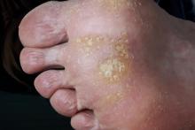 Is dit Pitted Keratolysis of niet?